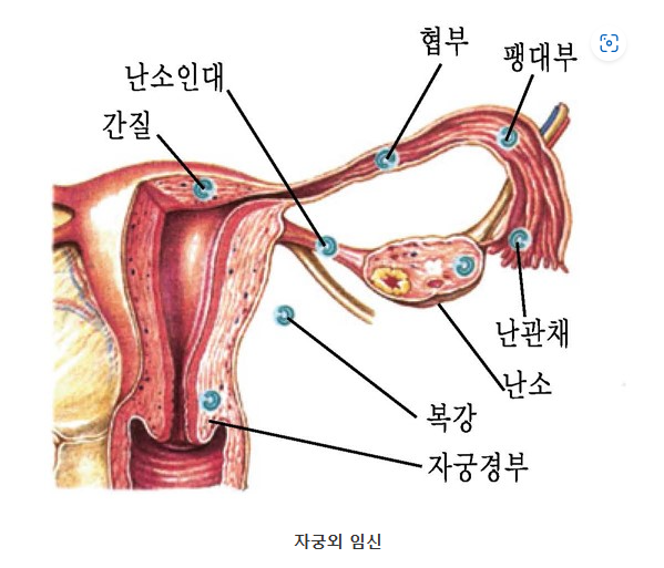 자궁외임신 이미지
