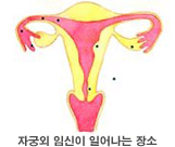 자궁외임신이 일어나는 장소 이미지