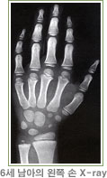 6세 남아의 왼쪽 손 X-ray 이미지