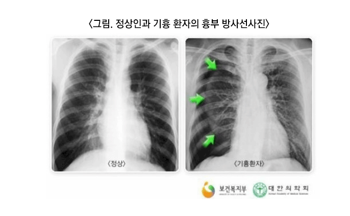 폐의 횡경막 표면